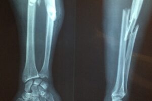 Diferencia entre fisura y fractura de hueso