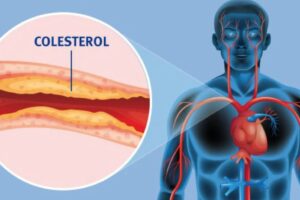 Diferencia entre Colesterol LDL y HDL